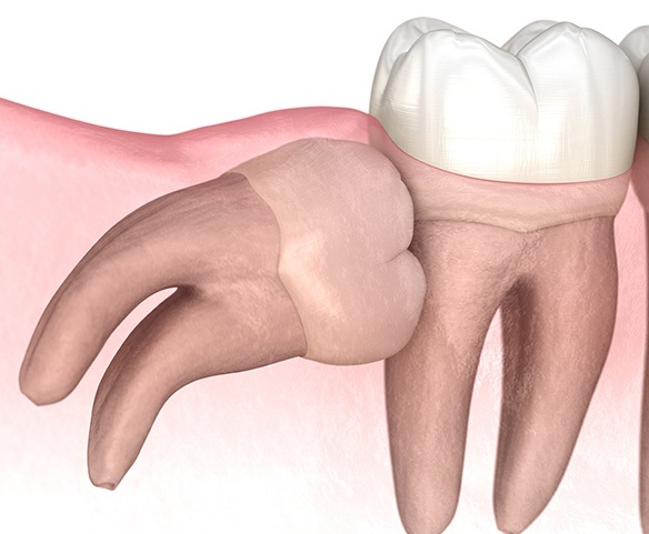 Animated impacted wisdom tooth