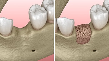 Before and after illustration of bone grafting in Lincoln