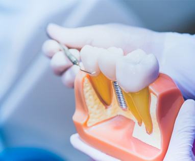 Periodontist holding model of dental implants in Lincoln, NE