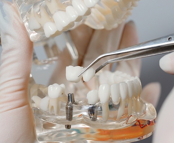 Model smile with dental implant supported fixed bridge