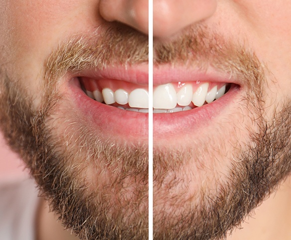 Before and after gum recontouring