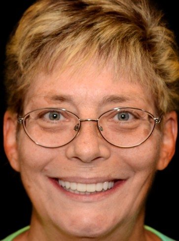 Female patient after hybridge dental implant restoration