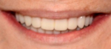 Closeup smile after hybridge dental implant restoration