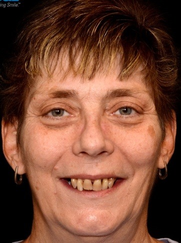 Female patient before hybridge dental implant restoration