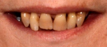 Closeup smile before hybridge dental implant restoration