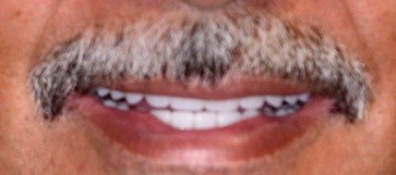 Closeup of man's smile after hybridge dental implants