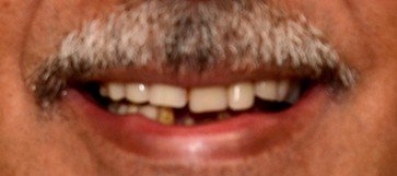 Closeup of man's damaged smile before hybridge dental implants