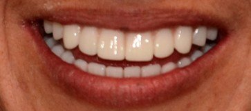 Closeup smile after hybridge dental implant placement