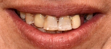 Closeup smile with tooth decay before hybridge dental implant placement