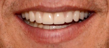 Male patient's smile closeup after dental implant restoration