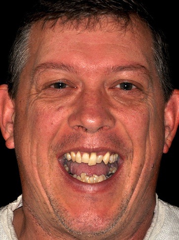Male patient before hybridge dental implant restoration