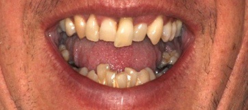 Male patient's smile closeup before hybridge dental implant restoration