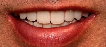 Male patient's smile closeup after hybridge dental implant placement