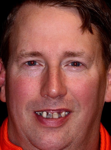 Male patient's smile before hybridge dental implant placement