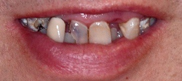 Male patient's smile closeup before hybridge dental implant placement