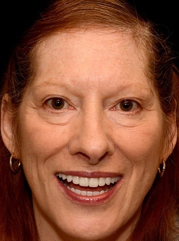 Woman's smile after hybridge dental implant denture placement