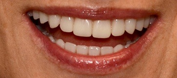 Woman's smile closeup after dental implant denture placement