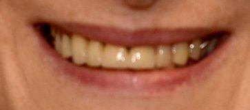 Woman's smile closeup before hybridge dental implant denture placement
