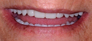 Woman's smile closeup after tooth replacement with hybridge dental implant restoration