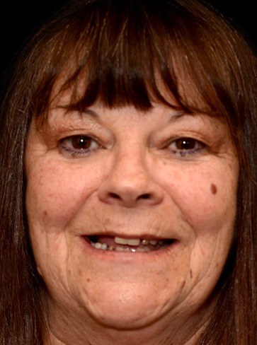 Woman with numerous missing teeth before hybridge dental implant restoration