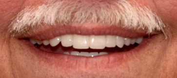 Closeup of man with top and bottom hybridge denture