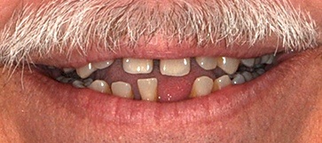 Closeup of man's smile with missing top and bottom teeth before hybridge dentures