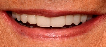 Closeup of woman's beautiful smile after hybridge denture placement