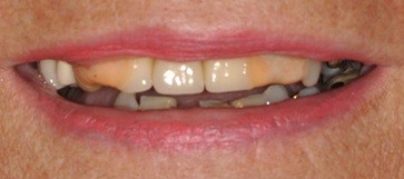 Closeup of woman's discolored smile before hybridge denture placement