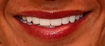 Closeup of woman's smile after hybridge dental implants