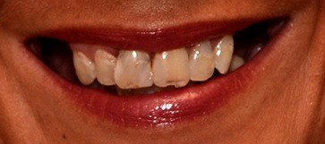 Closeup of woman's damaged smile before hybridge dental implants
