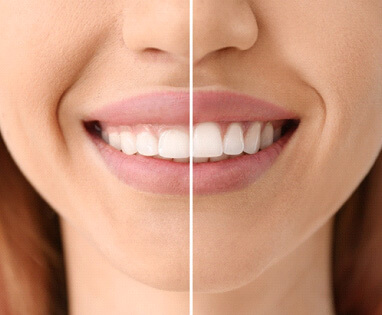 before and after of gum recontouring
