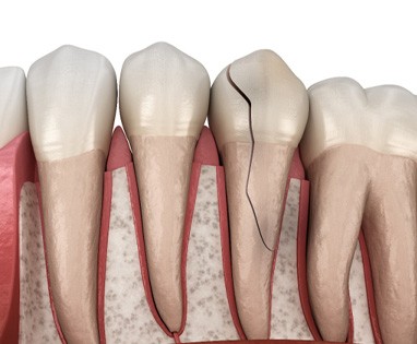 3D Render of a broken tooth