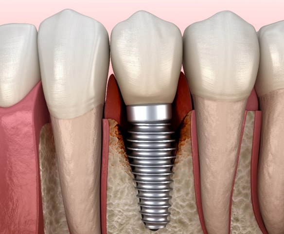 Illustration of a failed dental implant in Lincoln, NE
