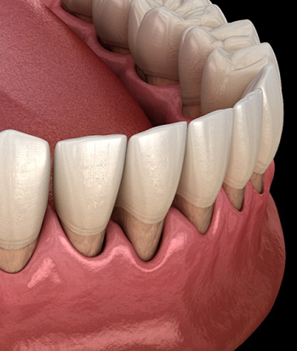 A diagram of a lower jaw experiencing gum recession.