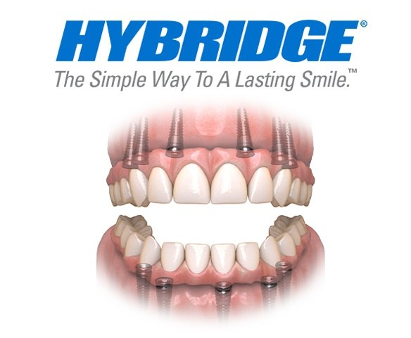 Animated hybridge dental implant supported denture