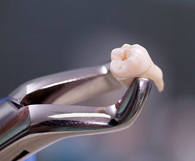 Closeup of forceps holding tooth after tooth extraction in Lincoln 