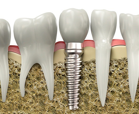 Diagram of dental implants after bone regeneration in Lincoln