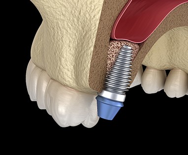 Diagram of dental implant after sinus lift in Lincoln 