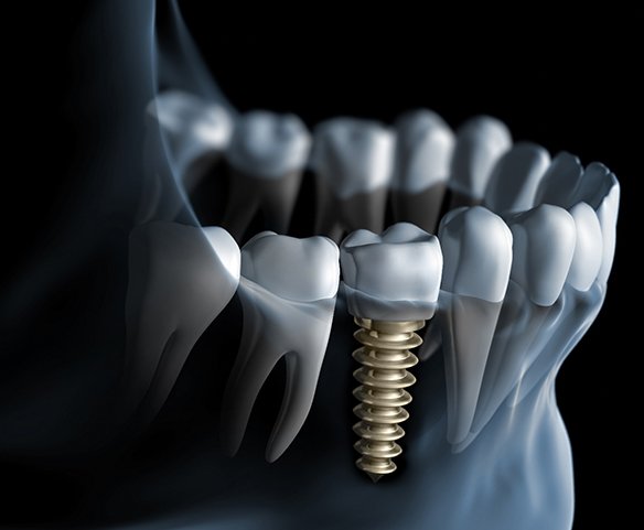 Animated parts of dental implant replacement tooth