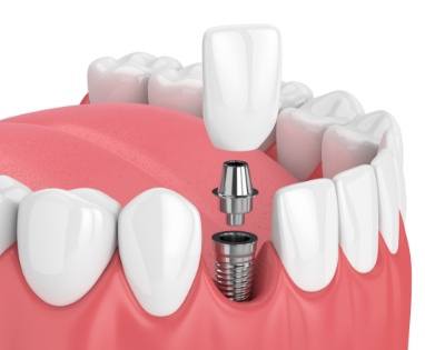 Animated parts of dental implant replacement tooth