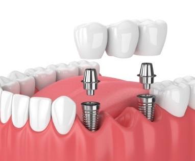 Animated parts of dental implant replacement tooth