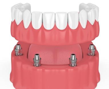 Animated parts of dental implant replacement tooth