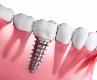 Diagram of a single tooth dental implant in Lincoln 