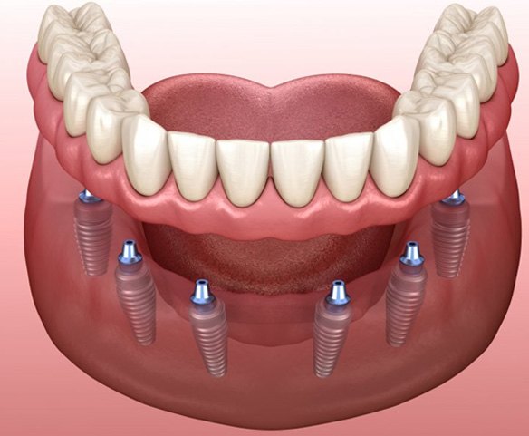six dental implants supporting a full denture 