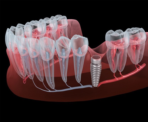 Illustration of failed dental implant in Lincoln, NE