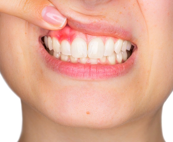 Pulling up lip to show signs of gum disease