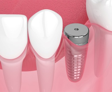 Dental implant in Lincoln, NE with protective cap