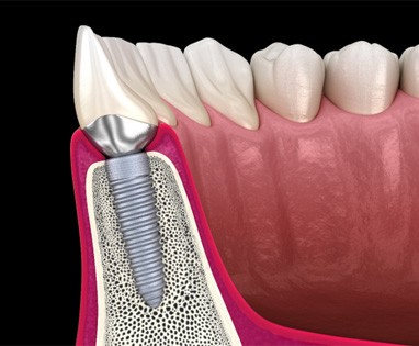 Render of a dental implant in Lincoln, NE with crown