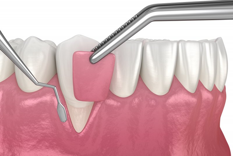 Illustration of gum grafting for gum disease therapy