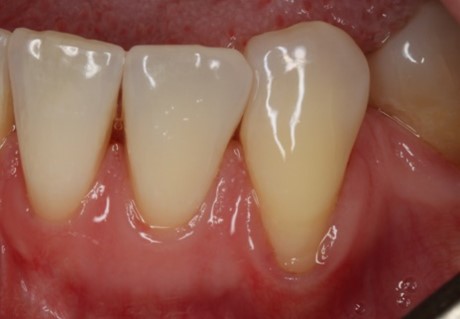Teeth and gums before gum grafting